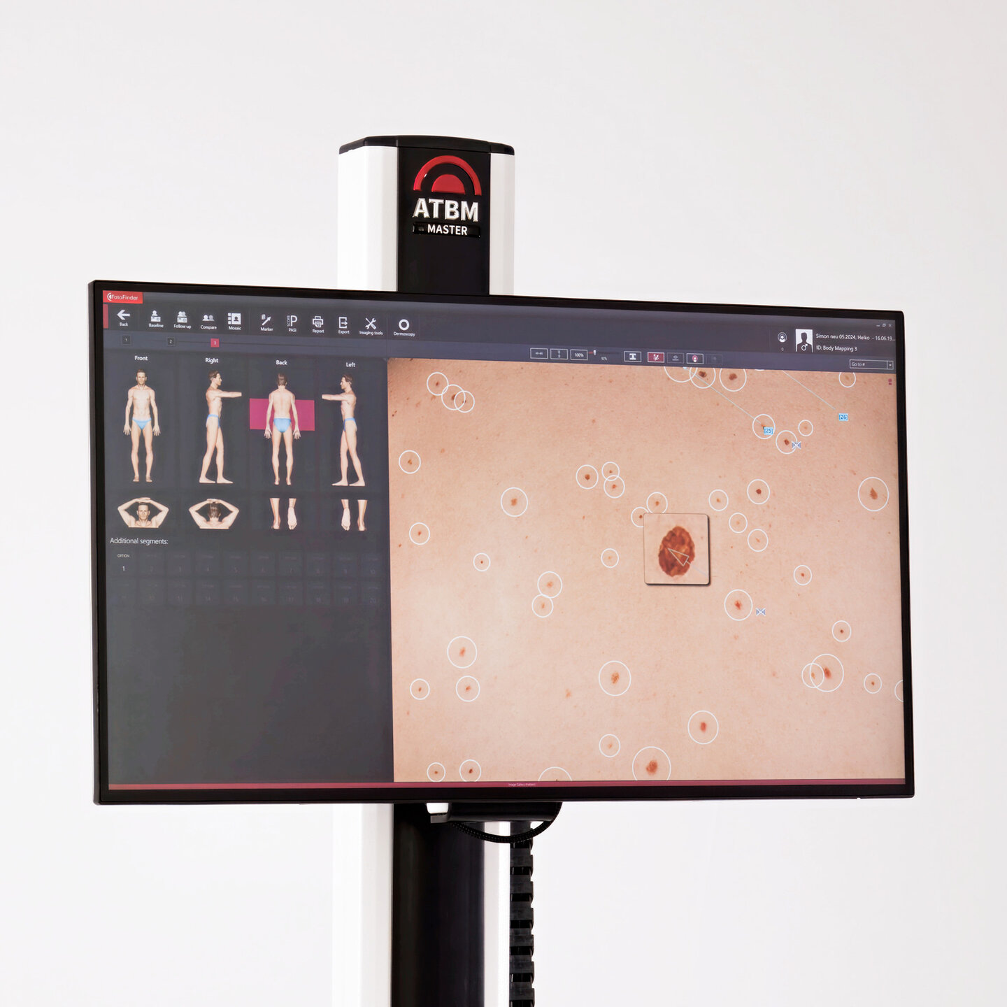 Monitor do ATBM master mostrando o mapa corporal com as lesões marcadas