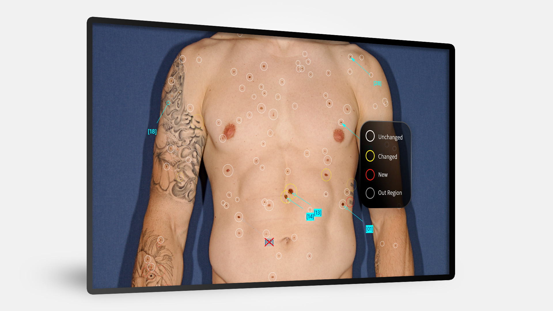 Tela do Bodyscan no software Universe, com anéis coloridos marcando lesões novas, alteradas e sem alteração